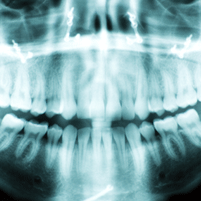 Digital X-Ray | SN Family Dental Center
