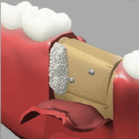 Bone Grafting