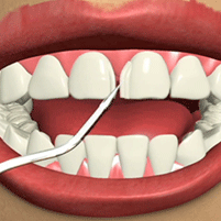 Dental Cosmetic Bonding