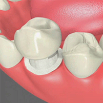 Dental Crowns