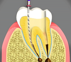 Root Canal Treatment