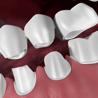 Dental Bridges