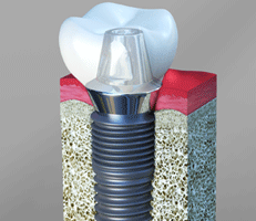 Dental Implants