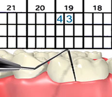 Scaling & Root Planing