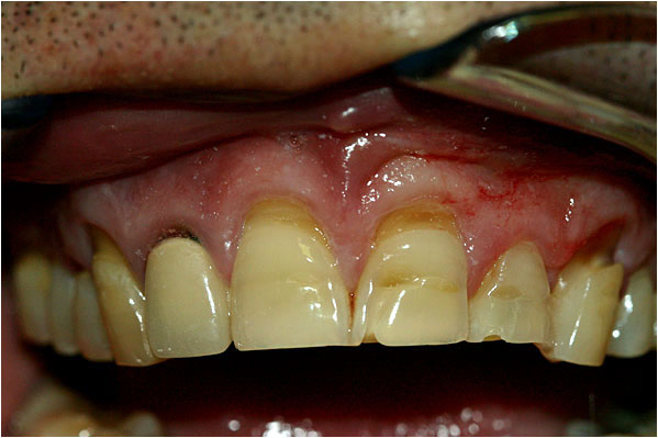 Dental Crowns Before 