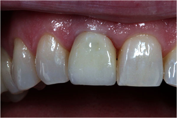 Dental Implants After 